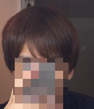 手術後 5ヶ月 20代の韓国植毛