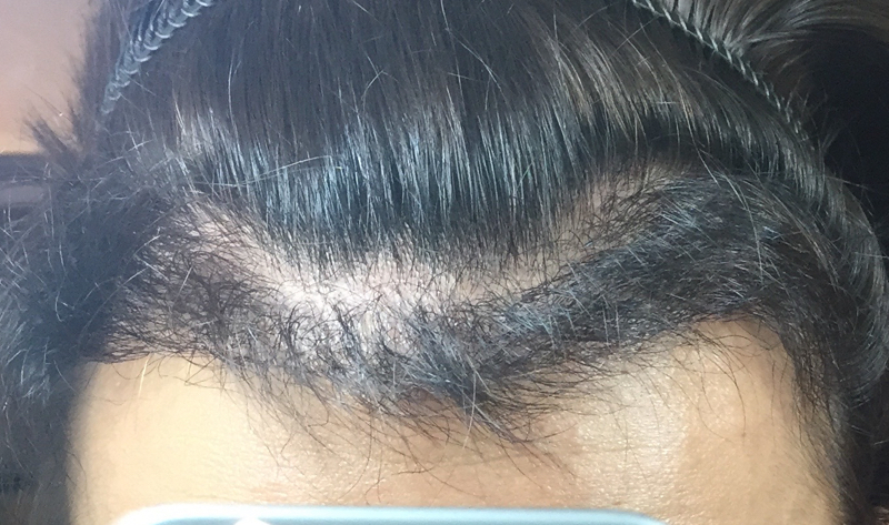 手術後 4ヶ月 代の韓国植毛