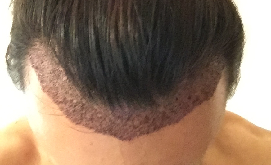 手術後2日目 代の韓国植毛